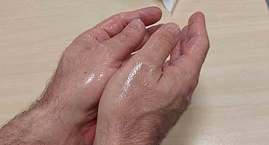 Aşırı terlemede krem tedavisi, ağır metal maruziyetine neden olabilir