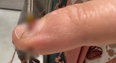 Eline dikiş iğnesi saplanan kadın hastanelik oldu