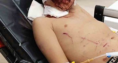 Erzurum'da küçük çocuğa köpekler saldırdı